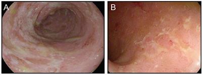 Checkpoint Blockade Toxicity and Immune Homeostasis in the Gastrointestinal Tract